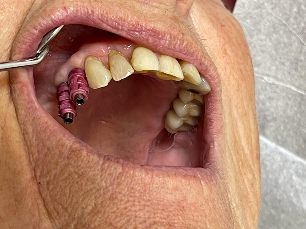 Implantat avtryck