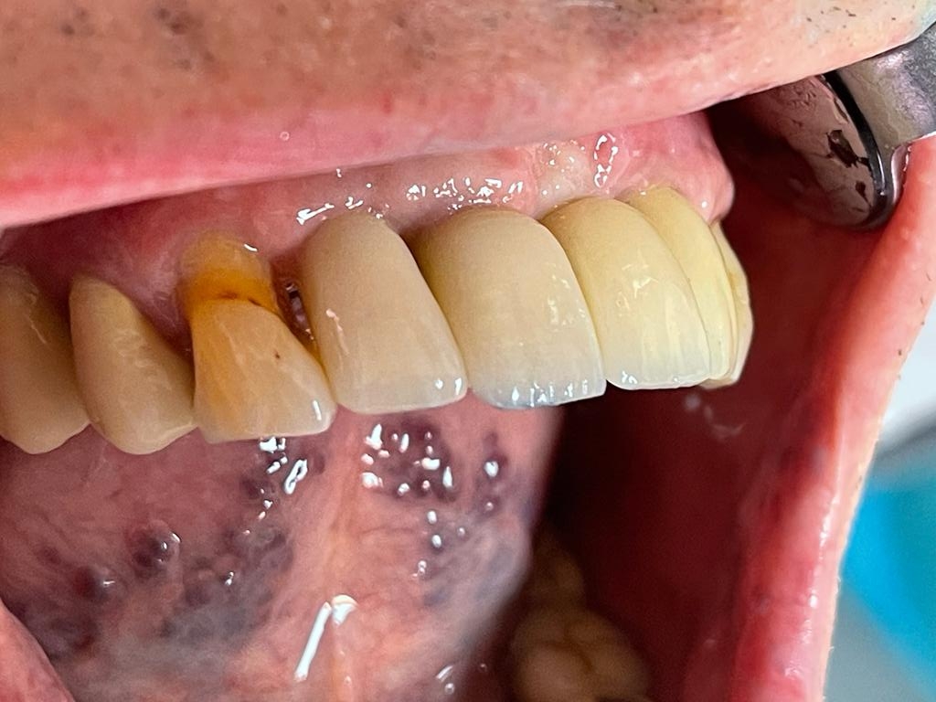 Implantat behandling fronttänder