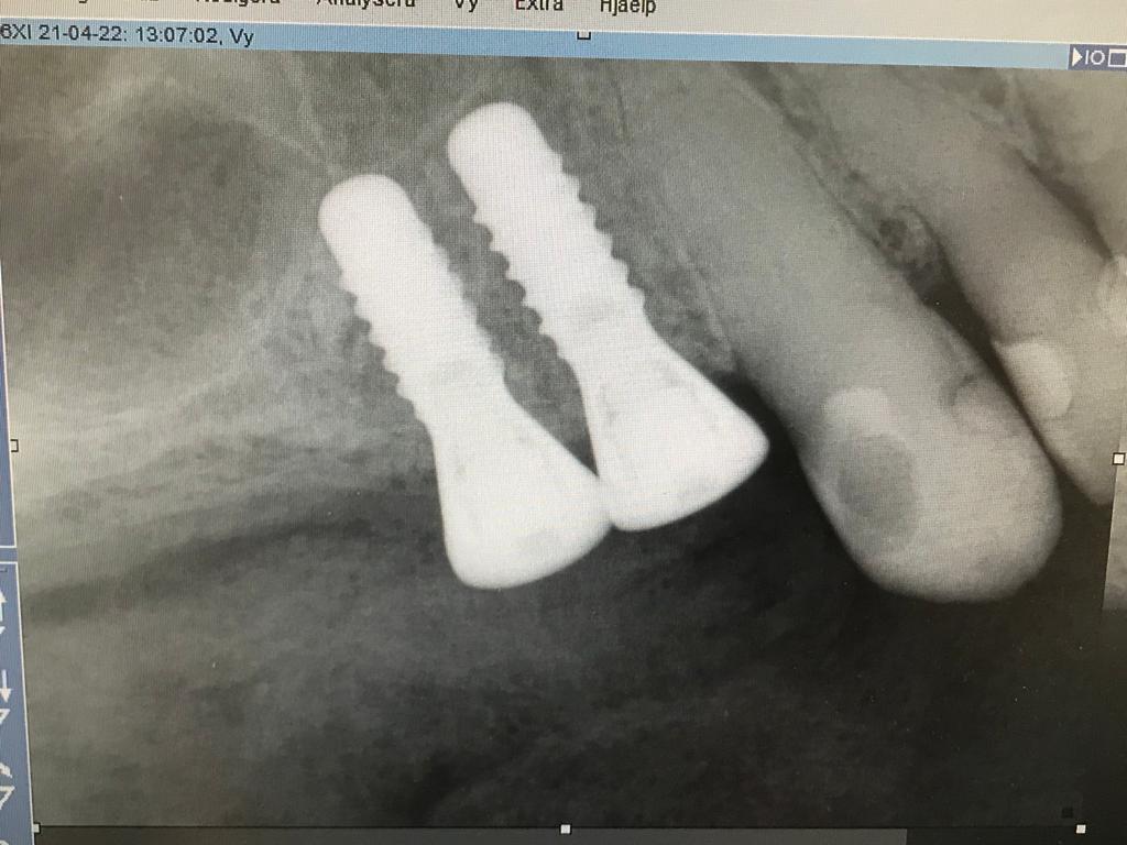 Implantat regio 14 15