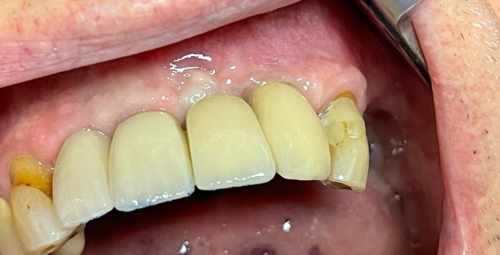 Implantat behandling fronttänder